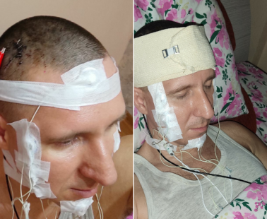 Αυτοχειρουργήθηκε στο σπίτι του για να βάλει τσιπ στον εγκέφαλό του