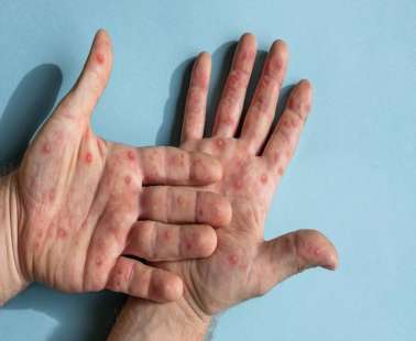 53 επιβεβαιωμένα κρούσματα της mpox