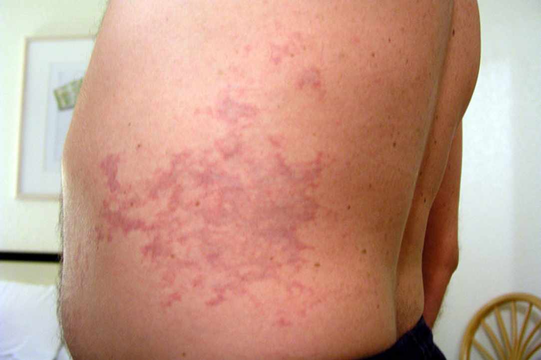 Diver's disease