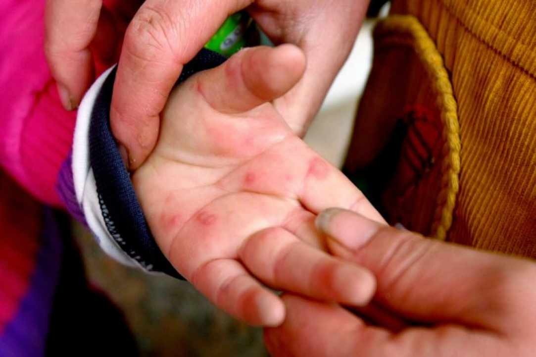 Αυξημένα κρούσματα Κοξάκι στα νηπιαγωγεία της Κύπρου