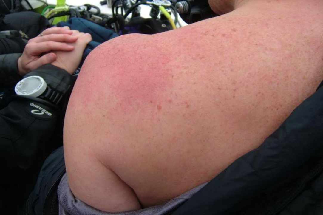 Diver's disease