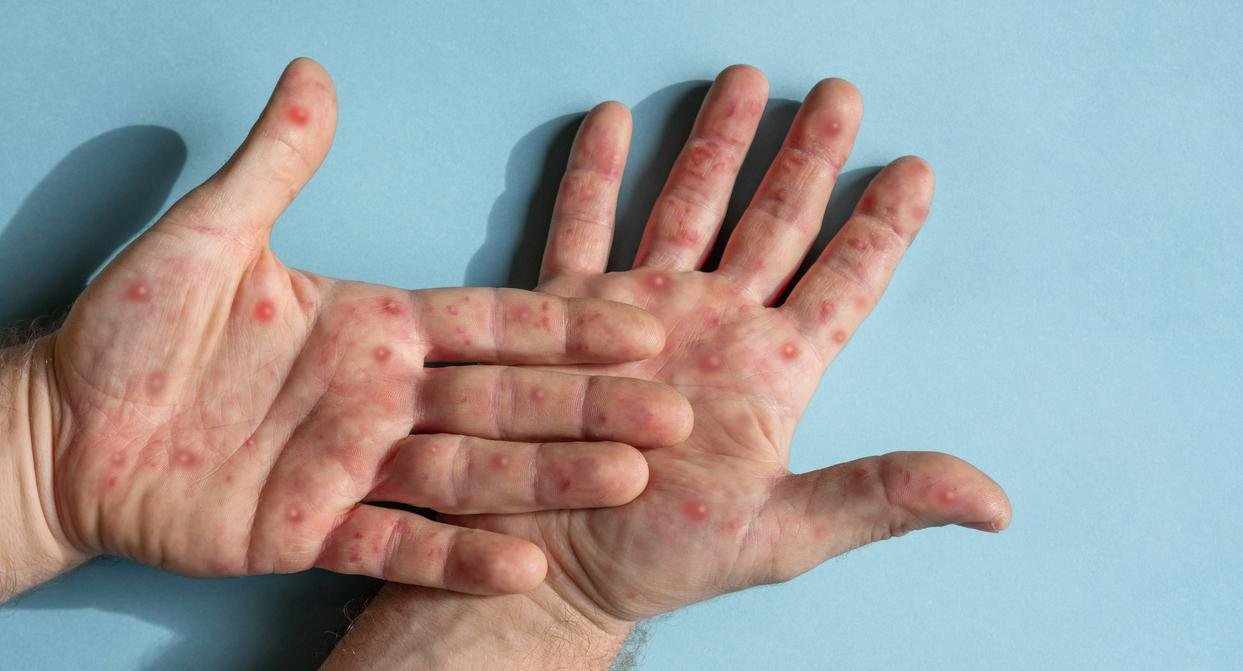 53 επιβεβαιωμένα κρούσματα της mpox
